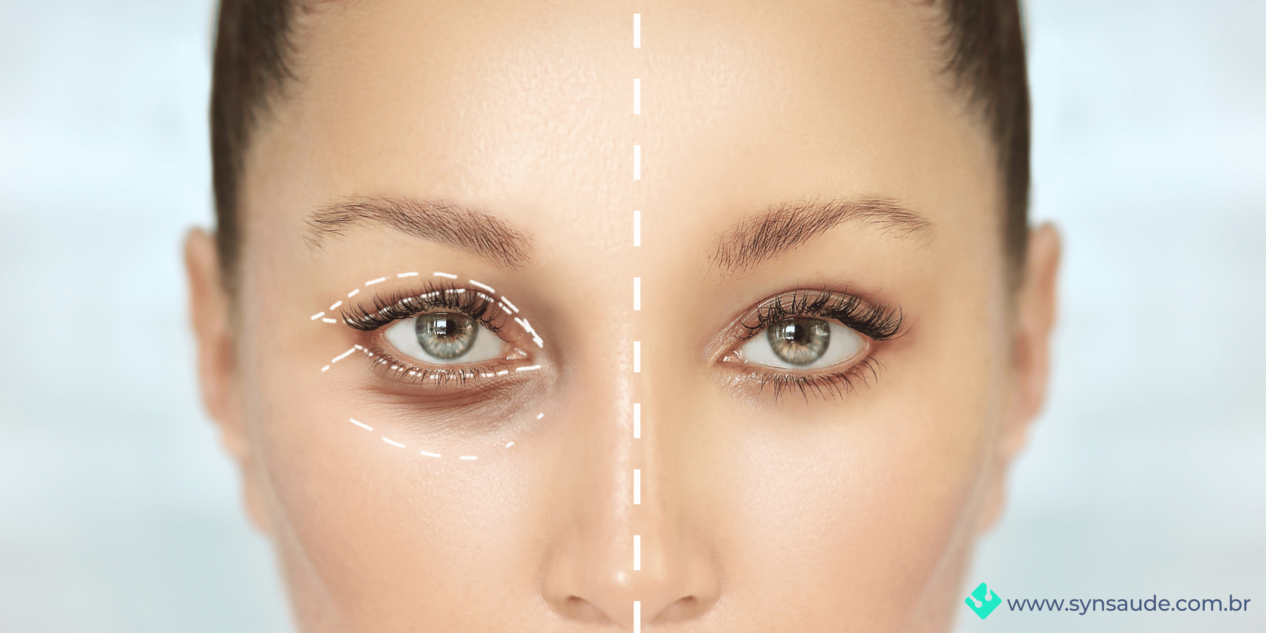imagem que mostra a correção feita pela cirurgia de blefaroplastia para correção de ptose