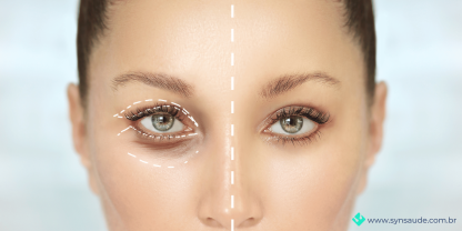 imagem que mostra a correção feita pela cirurgia de blefaroplastia para correção de ptose